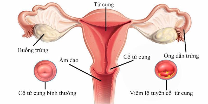 Tử cung là một bộ phận thuộc hệ thống sinh dục ở nữ giới