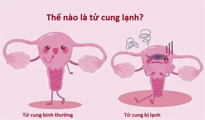 Triệu Chứng Tử Cung Lạnh: Nguyên Nhân, Dấu Hiệu và Cách Điều Trị Hiệu Quả