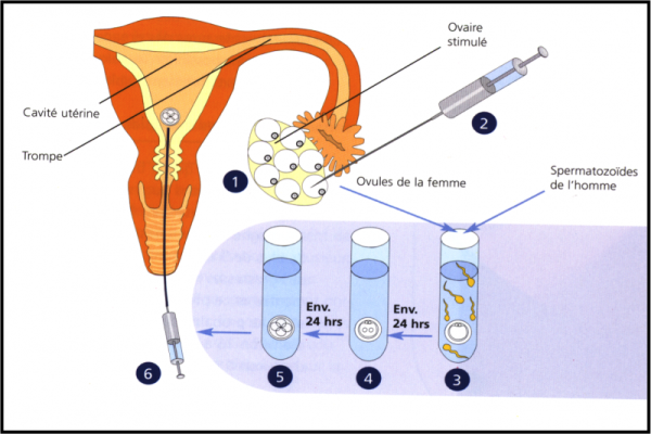 Thụ tinh ống nghiệm (IVF) là gì? Lợi ích và quy trình thực hiện